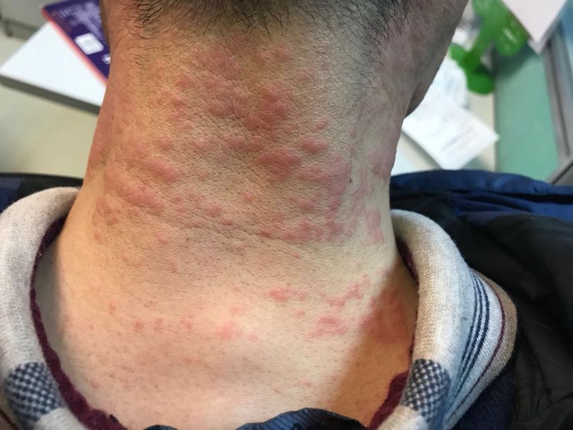 1、膏藥過(guò)敏怎么辦？