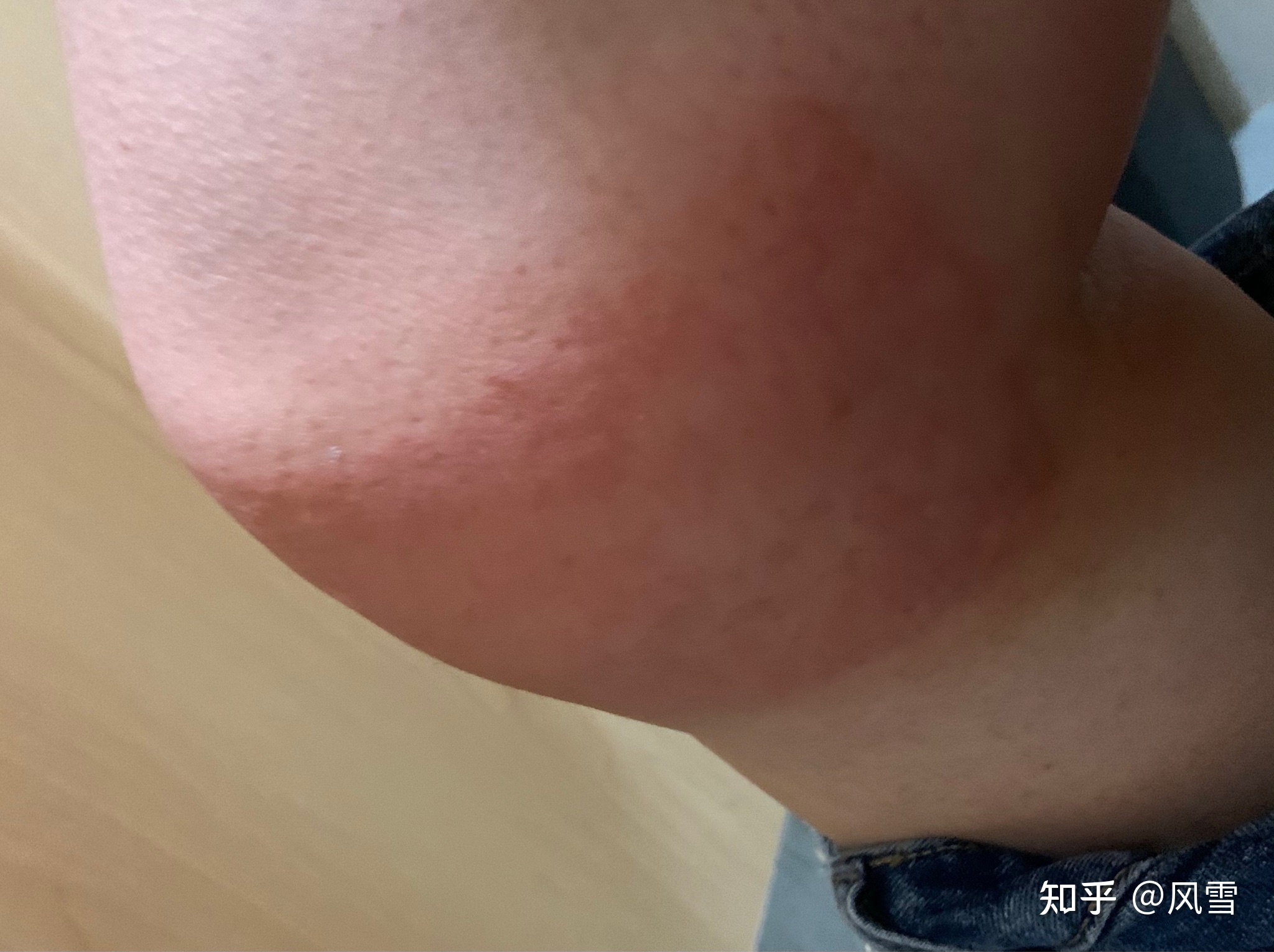 1、貼膏藥過敏癢紅腫怎么辦？