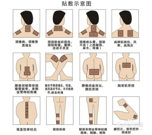 1、肩痛買什么膏藥可以貼？