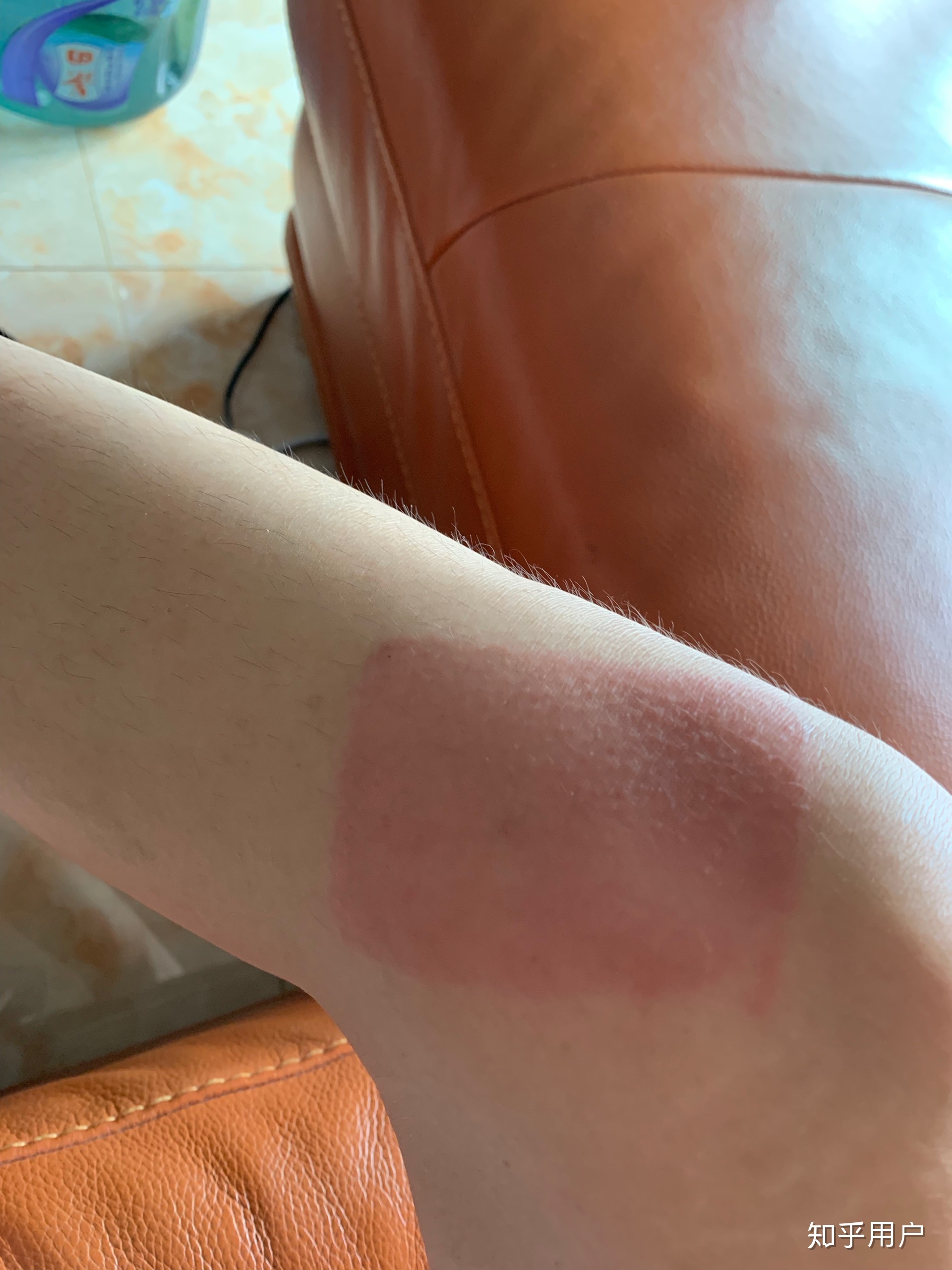 2、貼膏藥的地方有很多紅疙瘩，好不好？